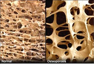 正常骨和骨质疏松骨的对比