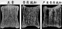 超声骨密度仪厂家为您介绍缺钙骨质疏松症