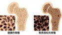 骨密度仪：骨质疏松十大认知误区（上）