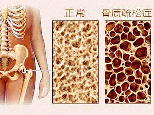 它骨骼强度的主要指标、简单方便、安全靠谱对骨代谢有很重要作用