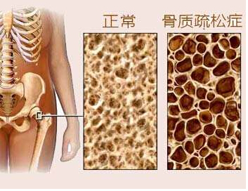 骨密度仪是检测骨密度T值得，骨密度又决定骨质疏松的重要指标