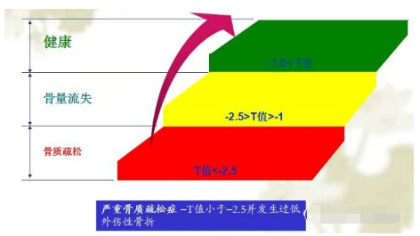 我们经常看到骨密度报告单中的Z 值和T 值有什么含义？