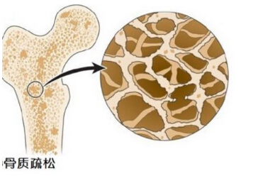 骨密度仪提示骨质疏松并非是老年人的“专利”五宜五忌不要掉以轻心