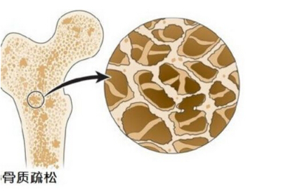 骨密度检测仪阐述多吃醋会让骨钙溶出而流失造成骨质疏松