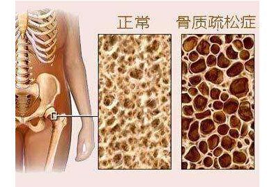 骨密度检测仪检测骨密度或高或低都不好,建议每年都要检测一次