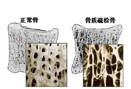 骨密度仪价格重要吗？不想骨骼脆弱医生教你看懂骨密度报告