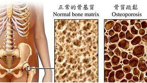 骨密度检测仪建议最好到有专业仪器的大医院进行正规的骨密度测定