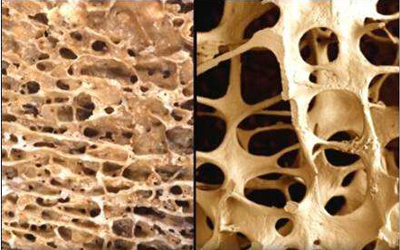 骨密度仪专家阐述我们平时用食疗补钙留住骨质的几大误区正好击中了你