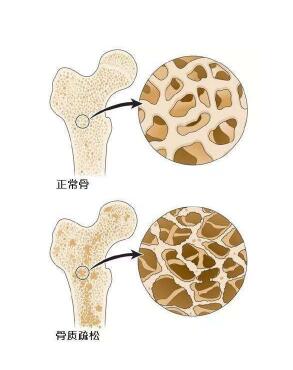 超声骨密度检测仪阐述爸妈变矮，催他们查骨密度预防骨质疏松