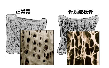 超声波骨密度仪阐述中老年不检测骨密度就像白蚁蛀房梁自行倒塌 超声波骨密度仪阐述中老年不检测骨密度就像白蚁蛀房梁自行倒塌