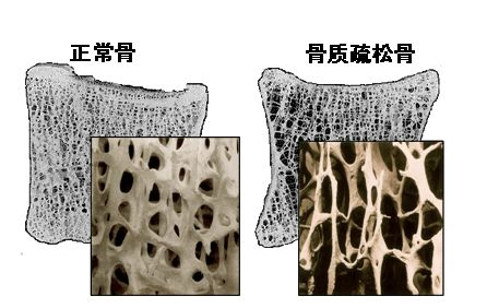 超声波骨密度仪阐述中老年不检测骨密度就像白蚁蛀房梁自行倒塌