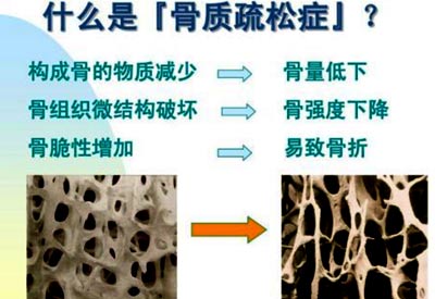 骨密度检查的仪器是什么_骨密度测试仪器专业检测骨密度预防骨质疏松