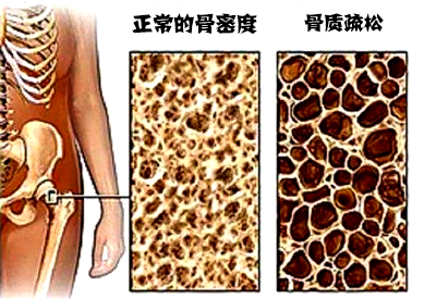 骨密度仪品牌介绍市场上最常用的骨密度设备看看哪种适合自己医院采购