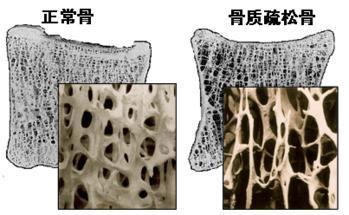 骨密度分析仪的价格是多少，要小心提防骨质疏松影响工作和生活