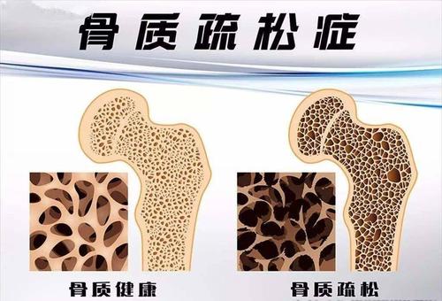 国产骨密度仪器有效预防骨质疏松症依赖于定期的骨密度测试