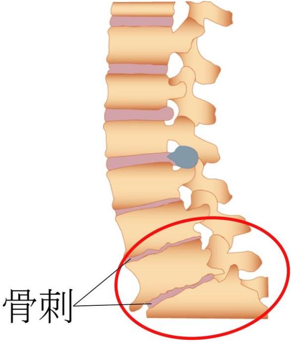 吉林长春|国康超声骨密度仪厂家品牌分享:为什么现在的年轻人也存在骨刺增生?